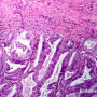 Endometrial adenocarcinoma, light micrograph